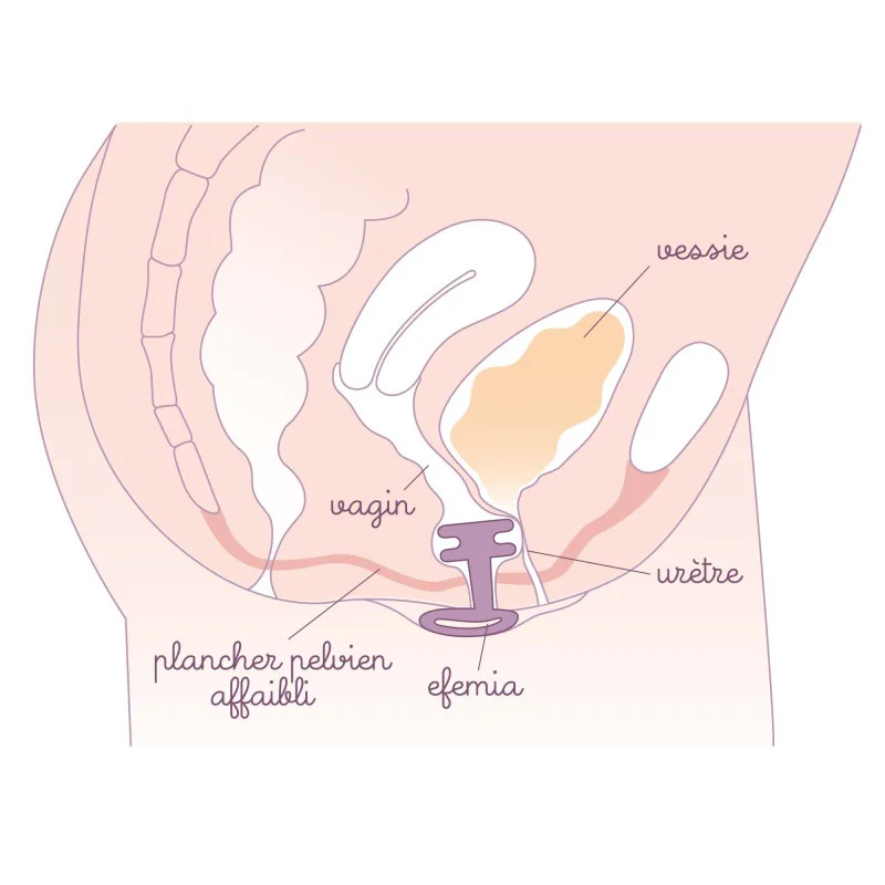 DEMONSTRATION Pessaire Efemia pour incontinence urinaire chez la femme