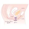 DEMONSTRATION Pessaire Efemia pour incontinence urinaire chez la femme