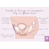 Carte anatomique réassignation de genre chez une femme trans