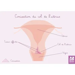 Carte anatomique Conisation...