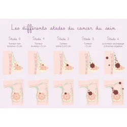 Carte différents stades du cancer du sein