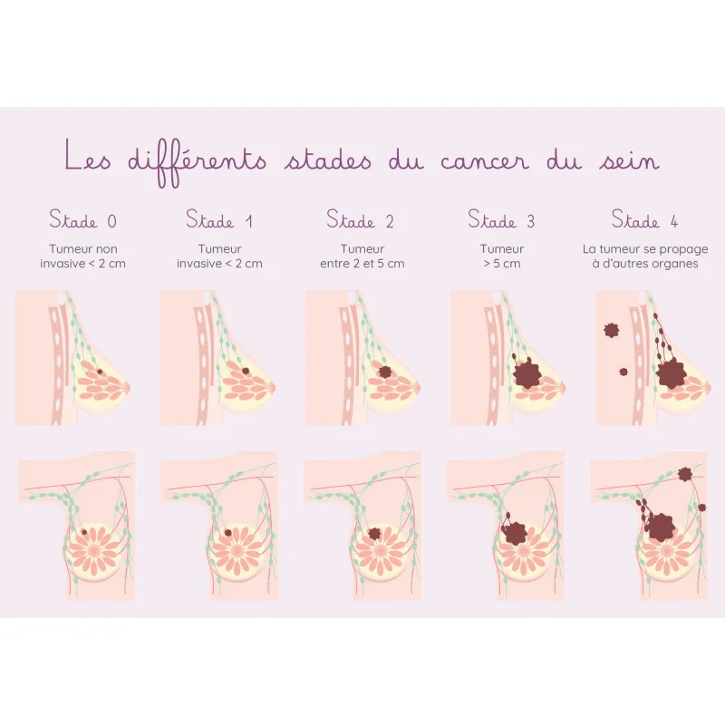 Carte différents stades du cancer du sein