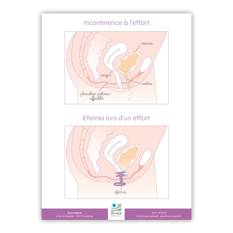 poster A4 sur l'utilisation du pessaire Effemia avec les schémas à l'effort