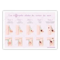 Carte différents stades du cancer du sein