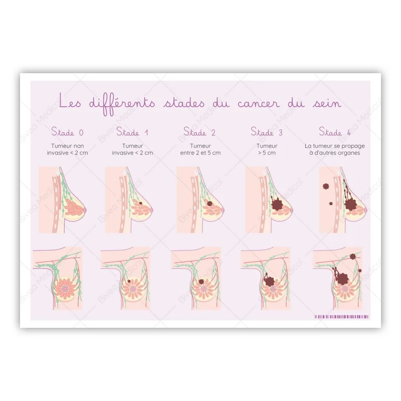 Carte différents stades du cancer du sein Carte différents stades du cancer du sein