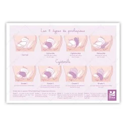 Schéma des différents types de prolapsus