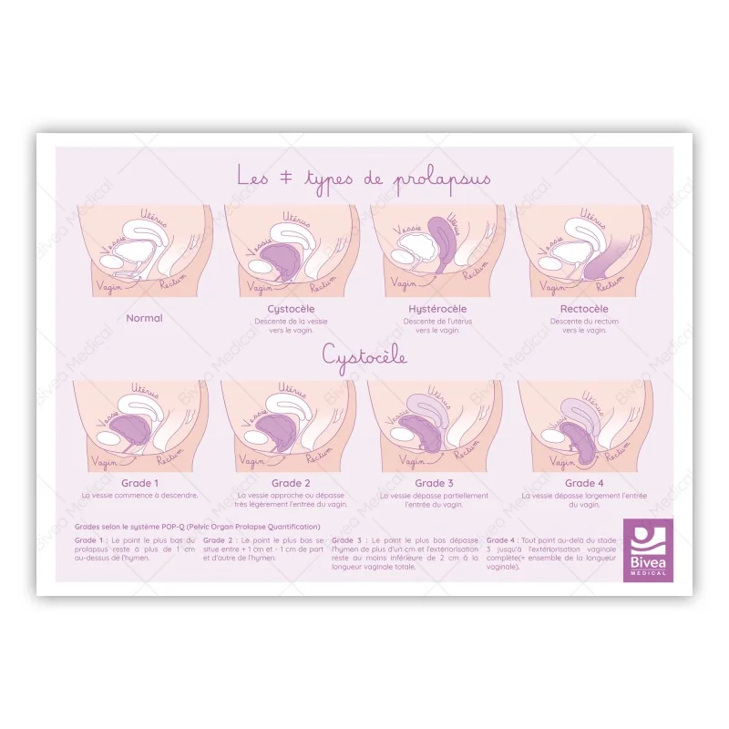 Schéma des différents types de prolapsus