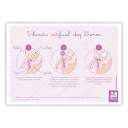 Schéma d'un sphincter artificiel chez l'homme et la femme
