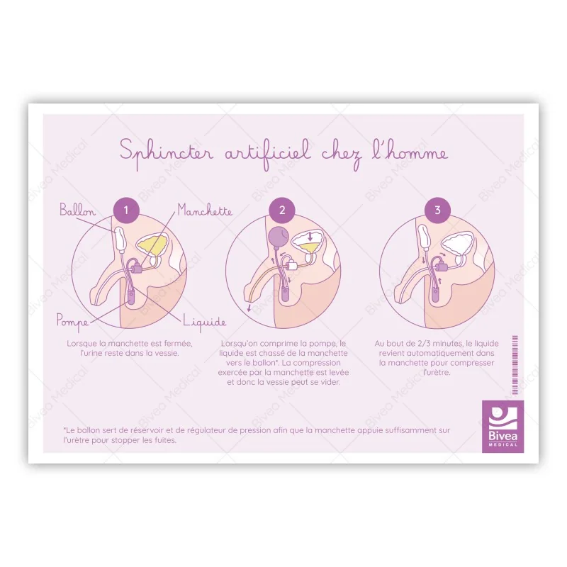Schéma d'un sphincter artificiel chez l'homme et la femme