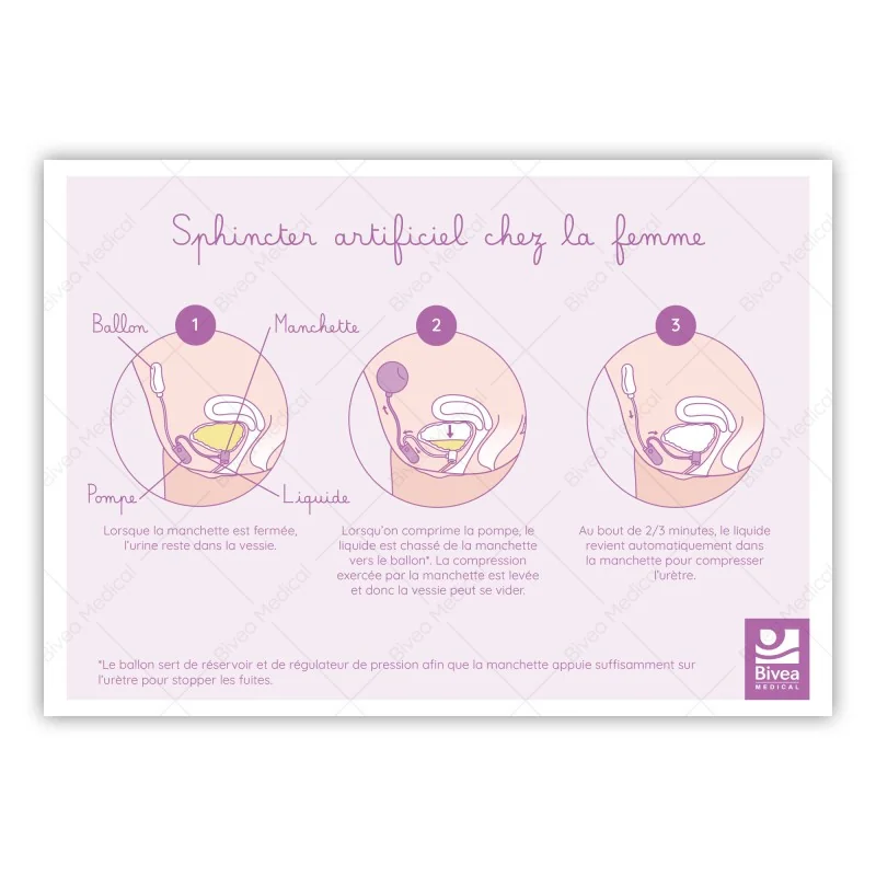 Schéma d'un sphincter artificiel chez l'homme et la femme
