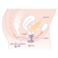 START SET Pessaire Efemia pour incontinence urinaire, Echantillon