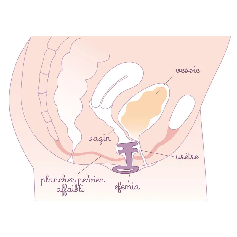 START SET Pessaire Efemia pour incontinence urinaire, Echantillon