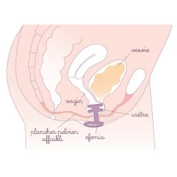 ECHANTILLON Pessaire Efemia pour incontinence urinaire chez la femme